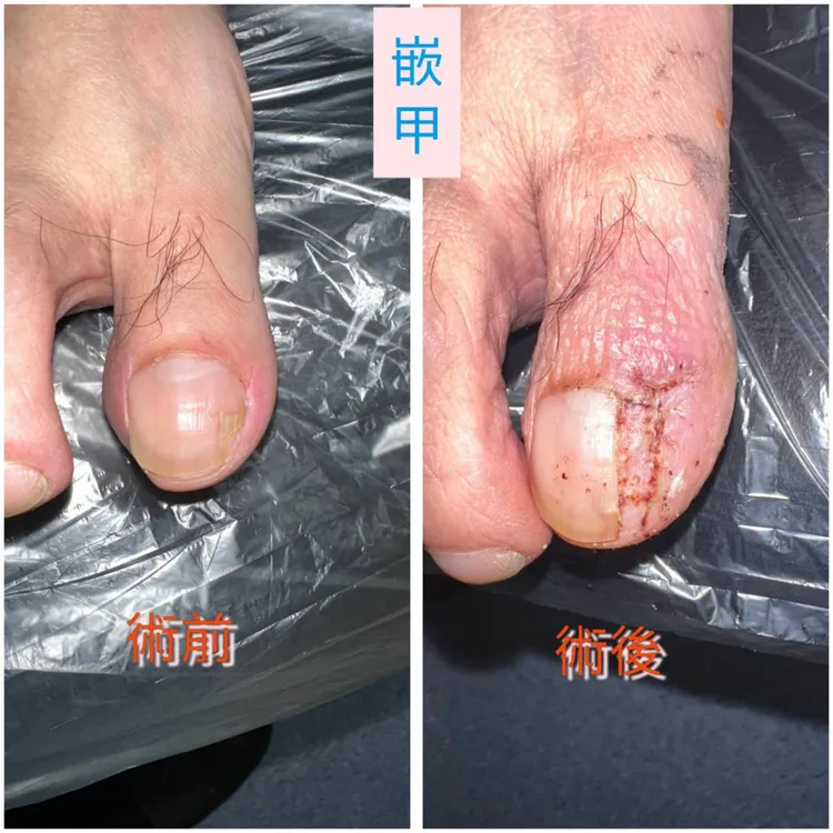 嵌甲術前術後。童綜合醫院提供