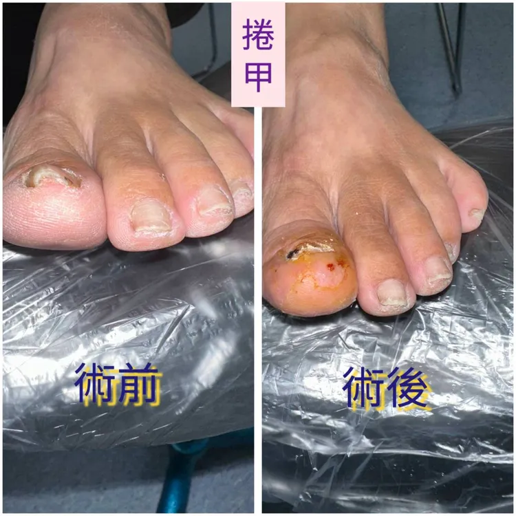 捲甲術前術後。童綜合醫院提供