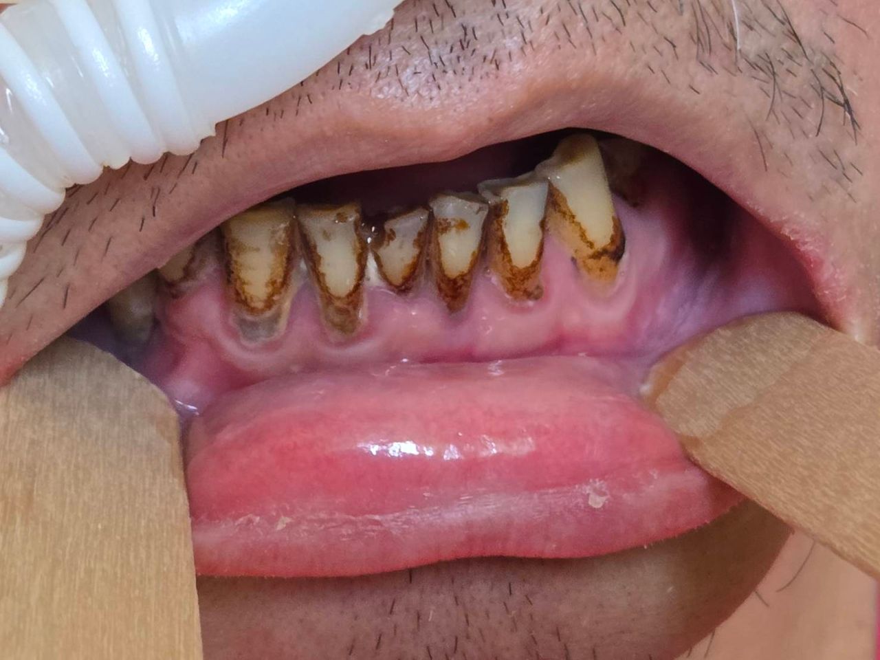 牙周病口腔細菌攻擊肺部 1天半變膿胸!52歲男鬼門關前獲救