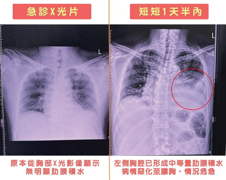 患者遭｢微小微單胞菌」感染，短短36小時病情惡化至膿胸。烏日林新提供