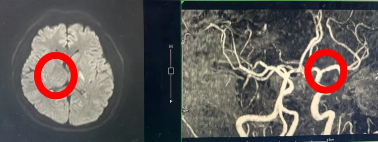 左圖為急性腦中風的範圍；右圖為血管有狹窄影響血液流通。豐原醫院提供
