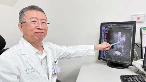 32歲廚師把手搖飲當水喝　結石引發腎水腫「痛到腳軟」