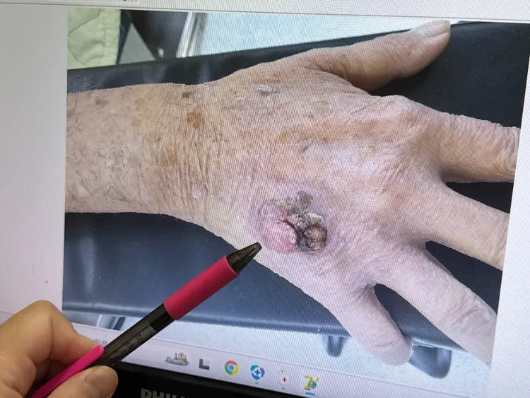 患者因病住院，意外揪出罹患皮膚癌。李綜合醫院提供