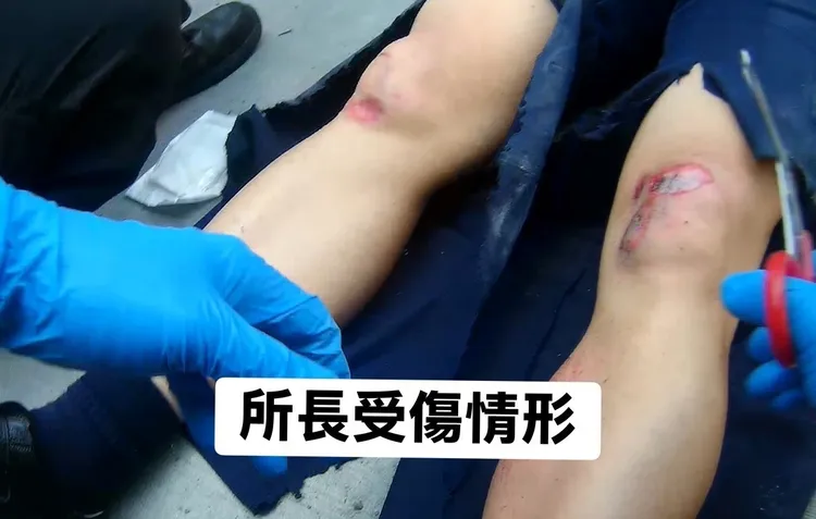 陳國銘經檢查發現右腳膝蓋骨裂、小腿骨折，緊急接受手術治療。民眾提供