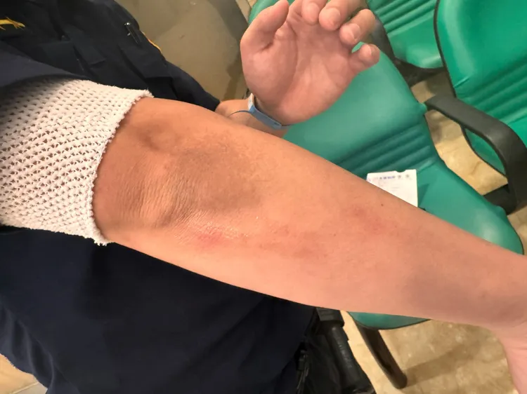 警員手肘挫傷。中壢警分局提供