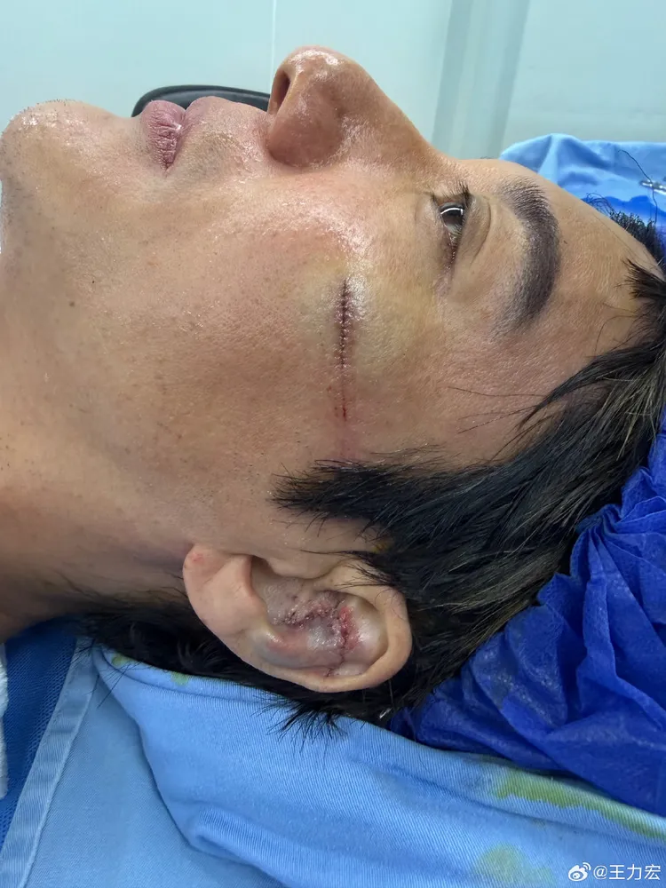 王力宏臉部縫12針，外耳軟骨撞碎縫了27針，傷勢讓人怵目驚心。摘自微博