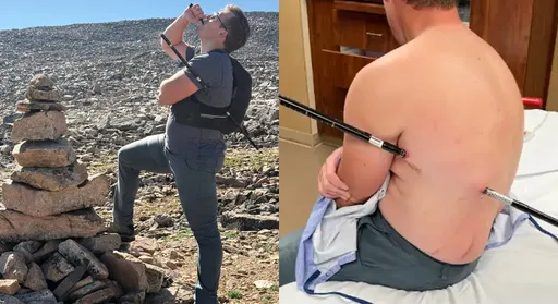護理師遭登山杖刺穿身體　「插著走下山」自救！醫師揭保命關鍵