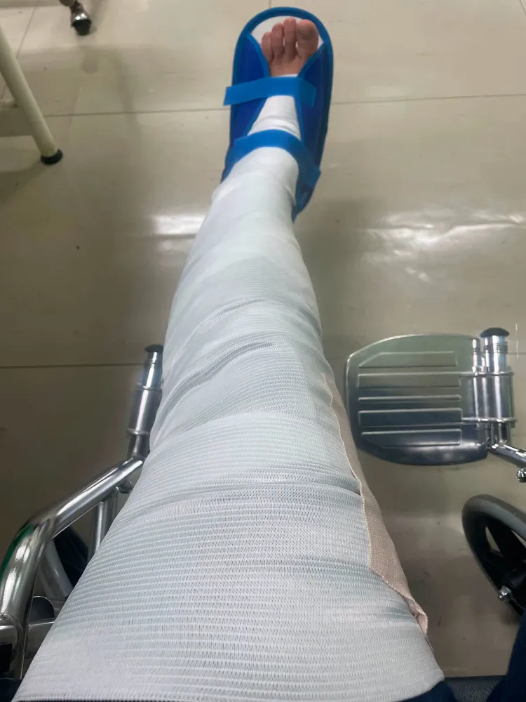 陳玉珍受傷打石膏。翻攝自陳玉珍臉書