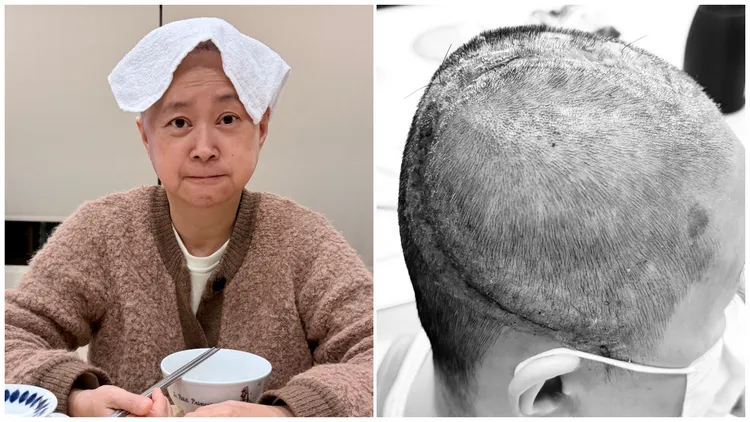 王月先前動開顱手術，康復後，她感謝主治醫師。翻攝自王月臉書