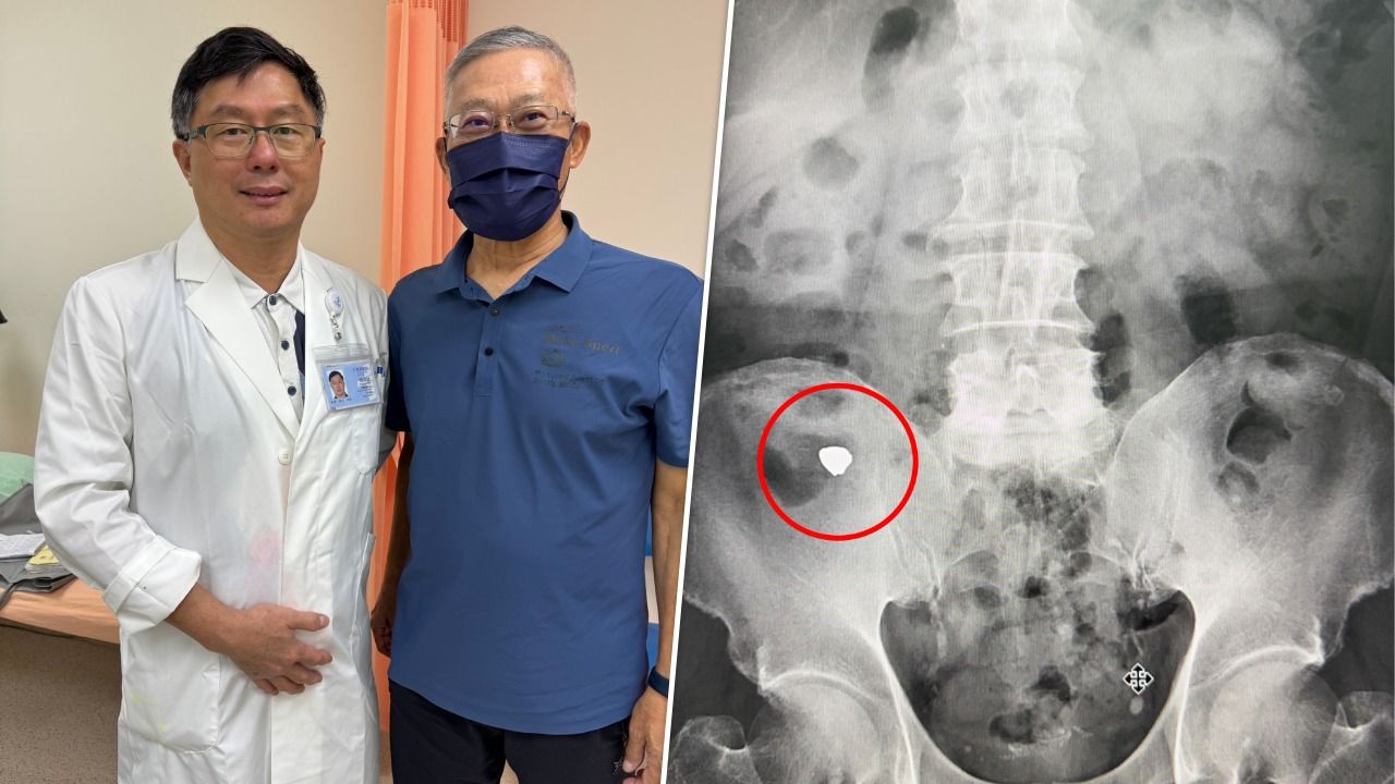 65歲男誤吞假牙卡大腸深處 內視鏡繞腸道120公分「撒網捕獲」