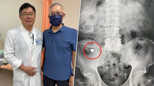 65歲男誤吞假牙卡大腸深處　內視鏡繞腸道120公分「撒網捕獲」
