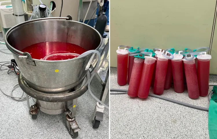 神經外科李政穎醫師曝光微創手術需消耗大量生理食鹽水情形。翻攝自「李腦師卡好-神經外科李政穎醫師」臉書粉專