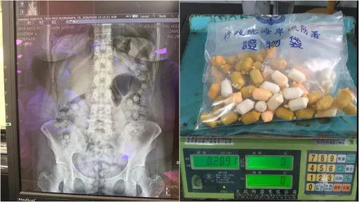 泰拳女教練人體運毒！高雄機場逮人　海巡陪住院10天等排出忍臭清洗證物