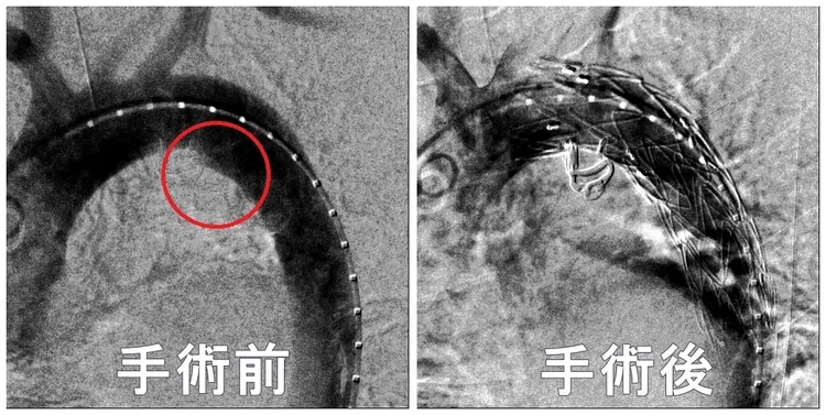 左方為穿透性主動脈潰瘍部位，經支架手術後將潰瘍病灶隔絕，防止血管壁惡化破裂。亞大附醫提供