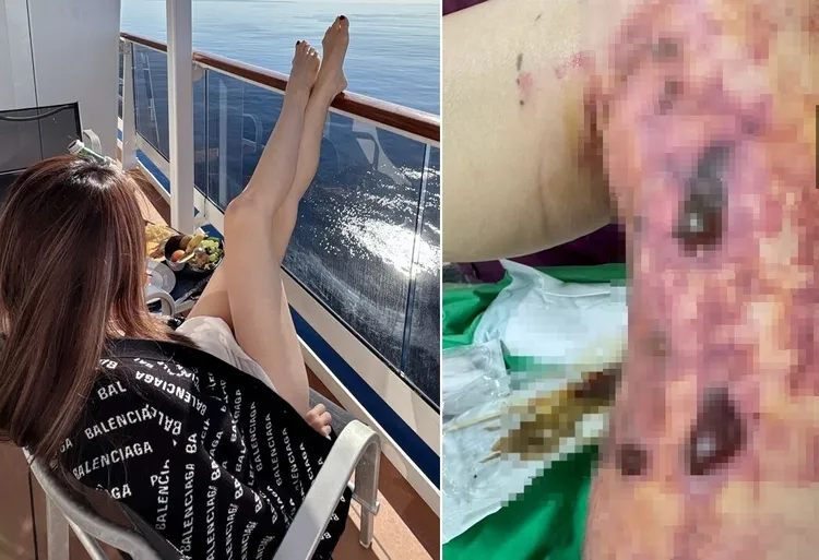 林姓美魔女原先有修長美腿，如今因血泡留下大片疤痕。
