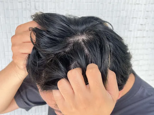 夏天頭皮狂出油？5大髮肌危機一次看　最慘狀況曝