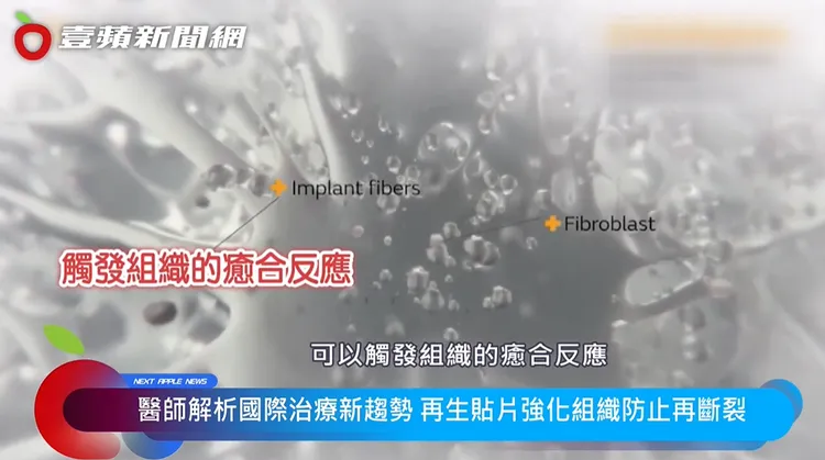 再生貼片能觸發組織的癒合反應，提供優質的生長環境。 