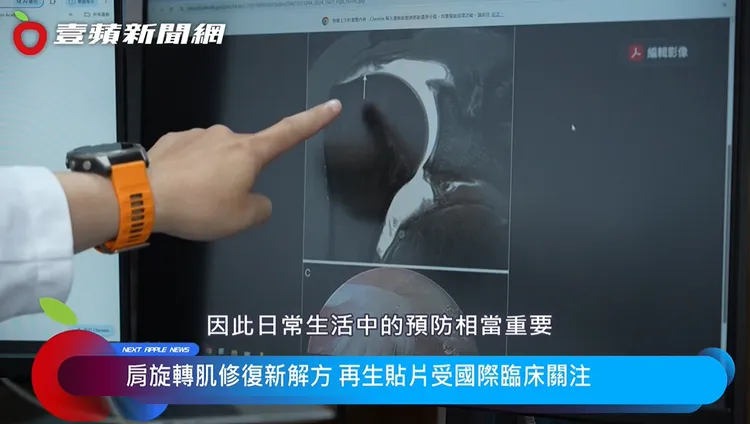 想要治好肩膀痛的問題，日常的保養也很重要，應避免長時間、反覆把手舉過頭，也要注意肩部保暖、睡姿以及運動前的暖身。