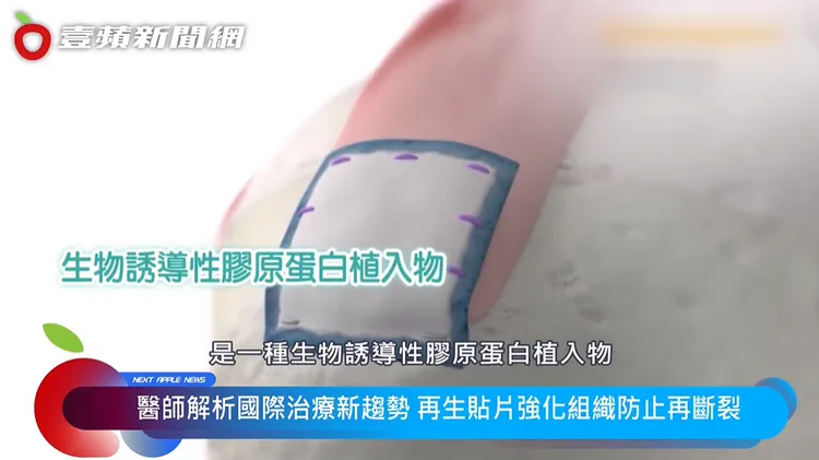 小小一片「再生貼片」，成為肩旋轉肌手術修復時的生物強化選擇。