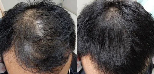 37歲男頭髮變細變少急求診　補充「含鋅食物」6週恢復髮量