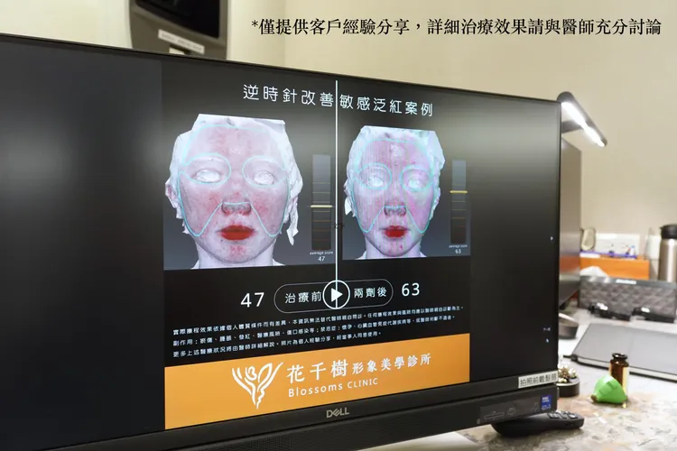 接受逆時針療程的敏感肌客戶（僅提供客戶經驗分享，詳細治療效果請與醫師充分討論）。張家玲攝