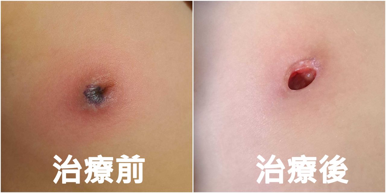 小一女童胸部紅腫劇痛 感染綠膿桿菌!右乳頭「幾乎被吃光」