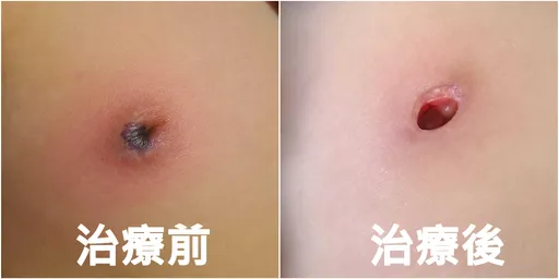 小一女童胸部紅腫劇痛　感染綠膿桿菌！右乳頭「幾乎被吃光」