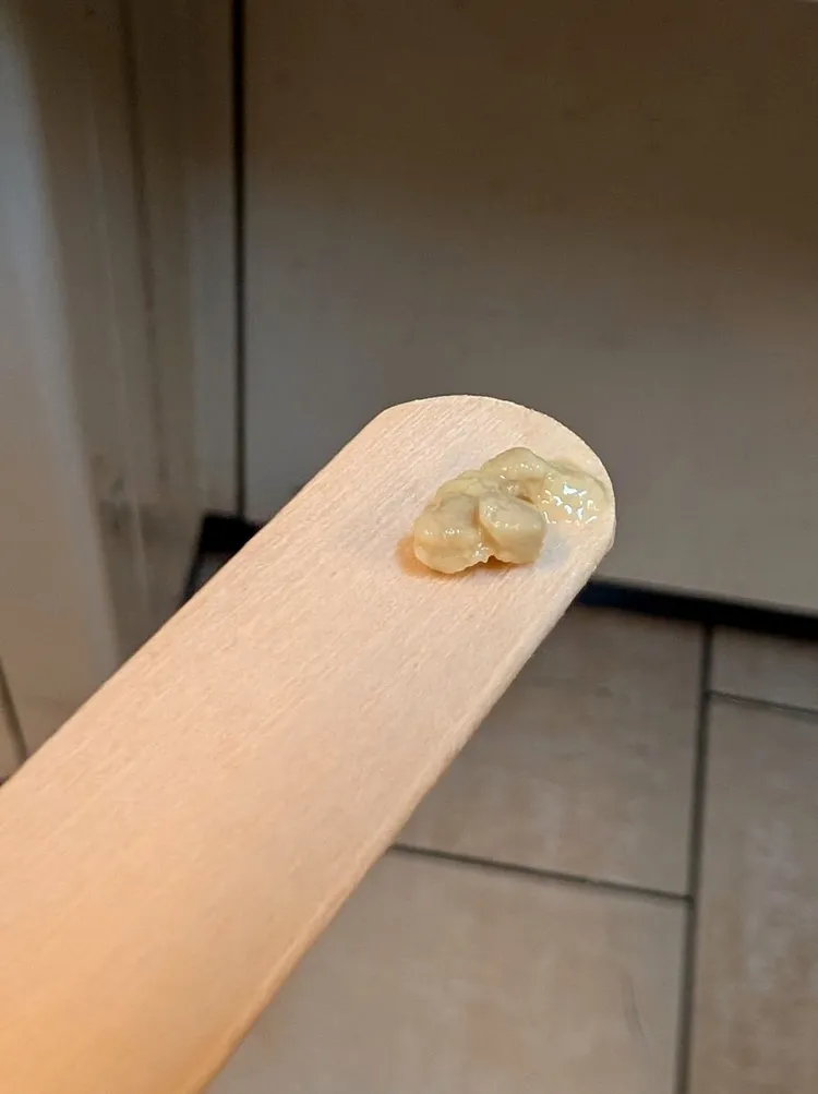 扁桃腺結石其實是扁桃腺慢性發炎的表現之一，結石容易藏在扁桃腺隱窩中。翻攝《李晏廷醫生 一生守護》粉專