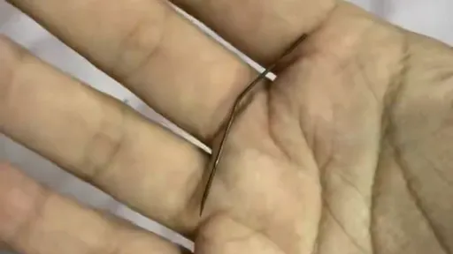 她左臀被刺「5cm生銹針頭」痛了1個月　網疑騎共享單車中招