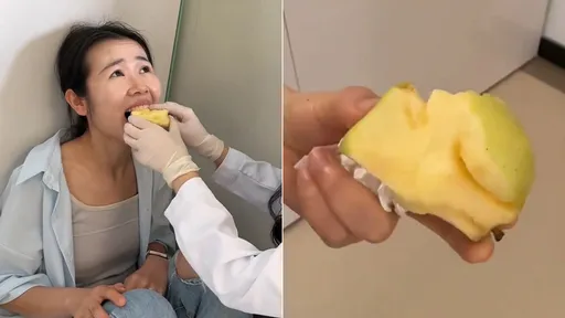 咬蘋果把嘴巴卡住了！　她就醫影片太爆笑