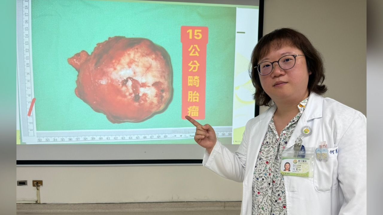 15公分腫瘤「壓扁肺臟」竟無感覺 24歲女求職體檢揪出畸胎瘤