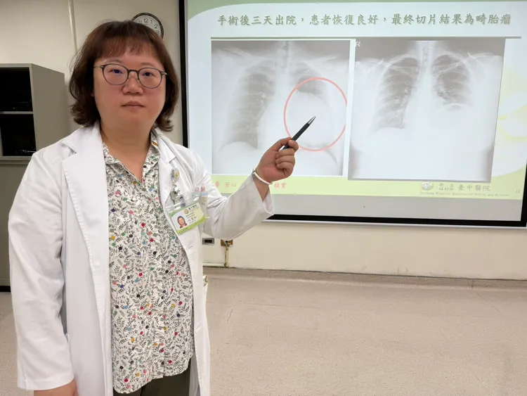 何蕙如醫師說明患者開刀前，左側縱隔腔巨大腫瘤幾乎把左肺壓扁（左圖），術後恢復了左肺應有的空間（右圖）。台中醫院提供