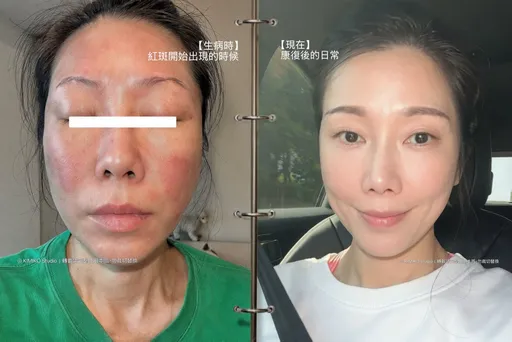 KIMIKO消失近2週　全身冒紅斑臉腫送急診「鬼門關走一遭」　